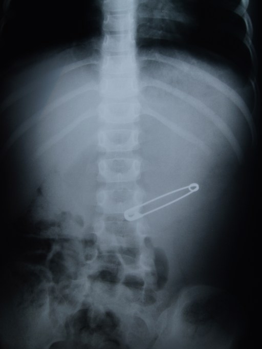 I was about 4. Funny now, but at the time (although still fairly amusing) worrying if it had been open or, if through the digestive process had popped open, it would have resulted in some major surgery. If you are also wondering – yes, I had to have every toilet trip checked and yes, the nappy pin was boiled and is kept with the x-ray. Beats a story about sticking a toy up your nose/in you ear.